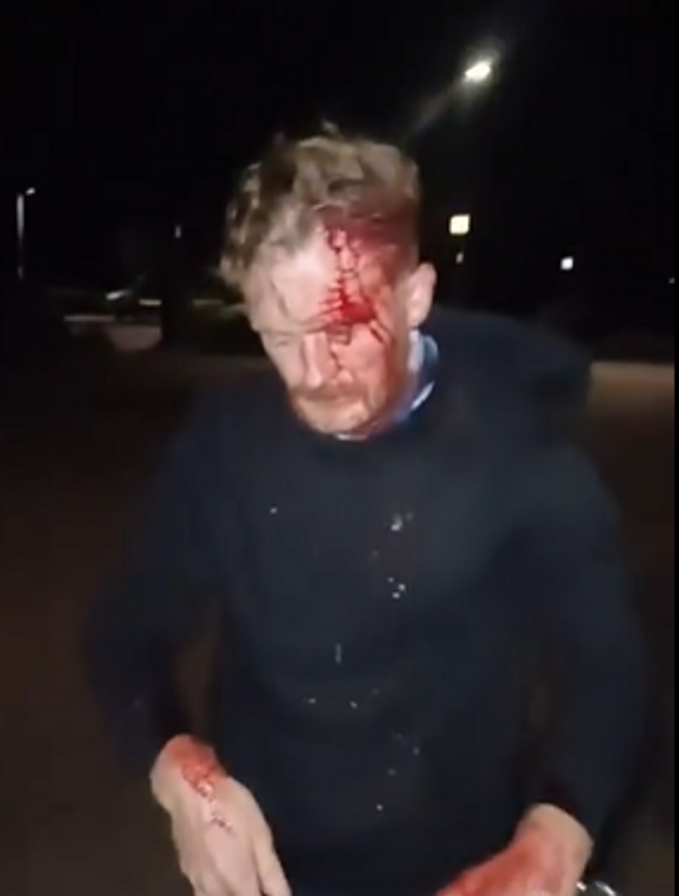 \u200bLouis can be seen bleeding from his head