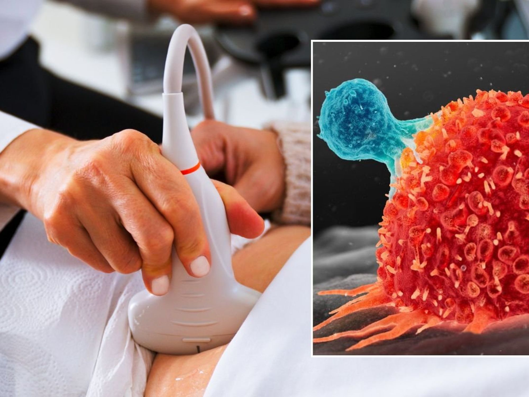 ULTRASOUND SCAN AND TUMOUR ILLUSTRATION