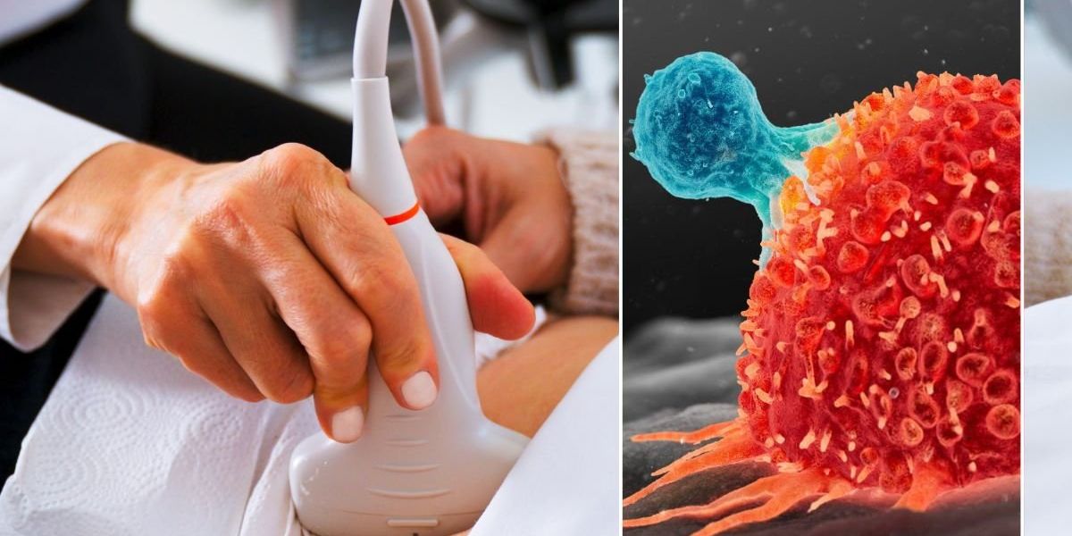 NextImg:Colon cancer warning: The foods rocketing your risk of the disease by up to 58% - new study
