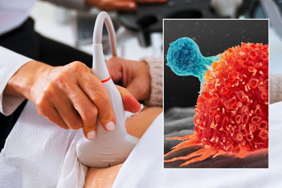 ULTRASOUND SCAN AND TUMOUR ILLUSTRATION
