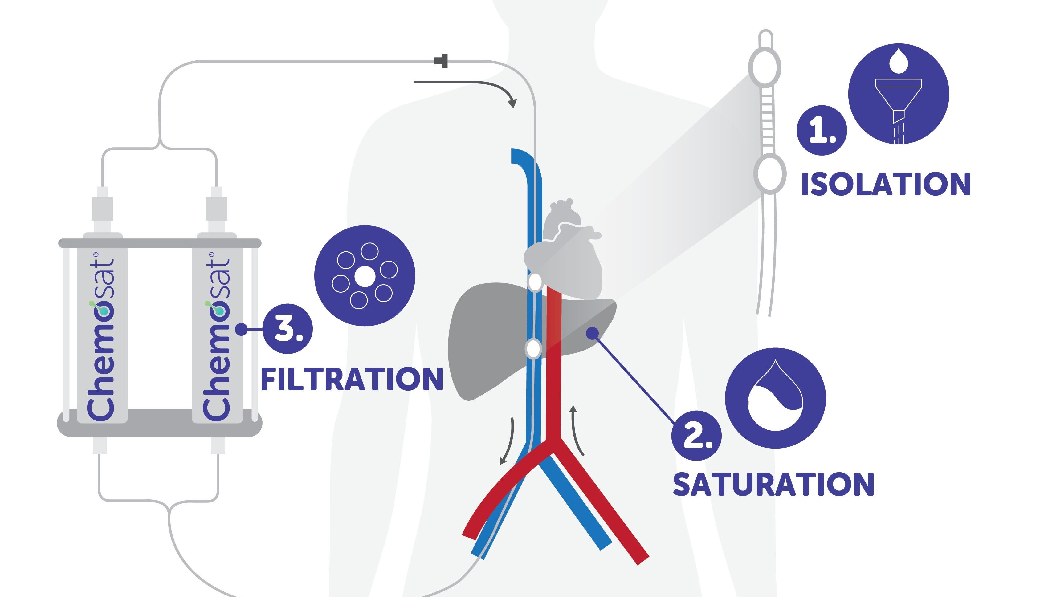 Undated handout illustration issued by PLANETS Cancer Charity of a revolutionary treatment for liver cancer which works by isolating the organ from the rest of the body and 'bathing' it in chemotherapy, which is effective in almost 90 per cent of patients, greatly improving survival rates. The procedure, known as chemosaturation therapy or percutaneous hepatic perfusion (PHP), has been pioneered in the UK by Dr Brian Stedman, a consultant interventional radiologist at University Hospital Southampton, and involves using two small balloons to divert blood past the liver for an hour while delivering drugs directly in to the organ. Issue date: Sunday April 3, 2022.