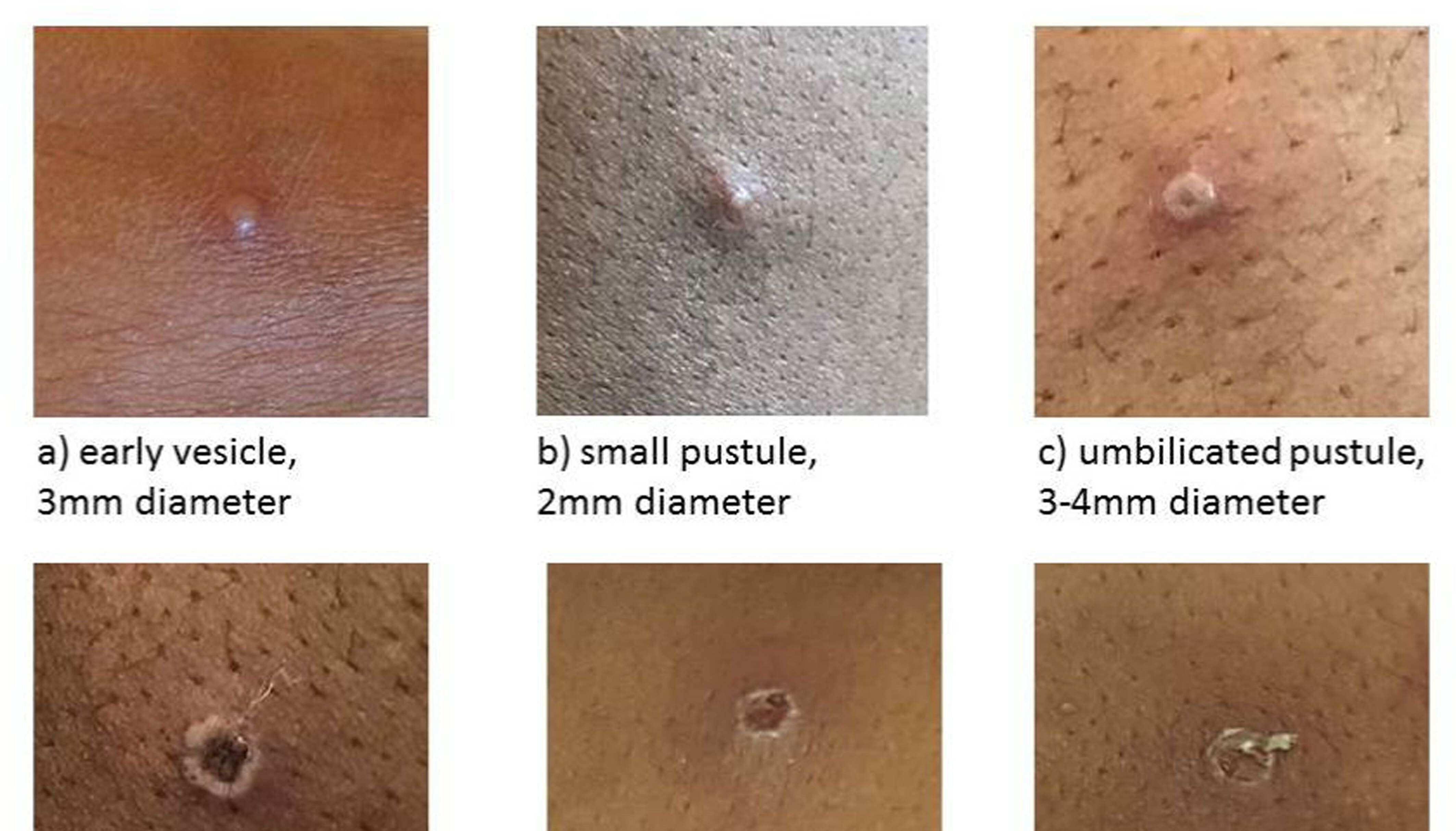 Undated handout image issued by the UK Health Security Agency of the stages of Monkeypox.