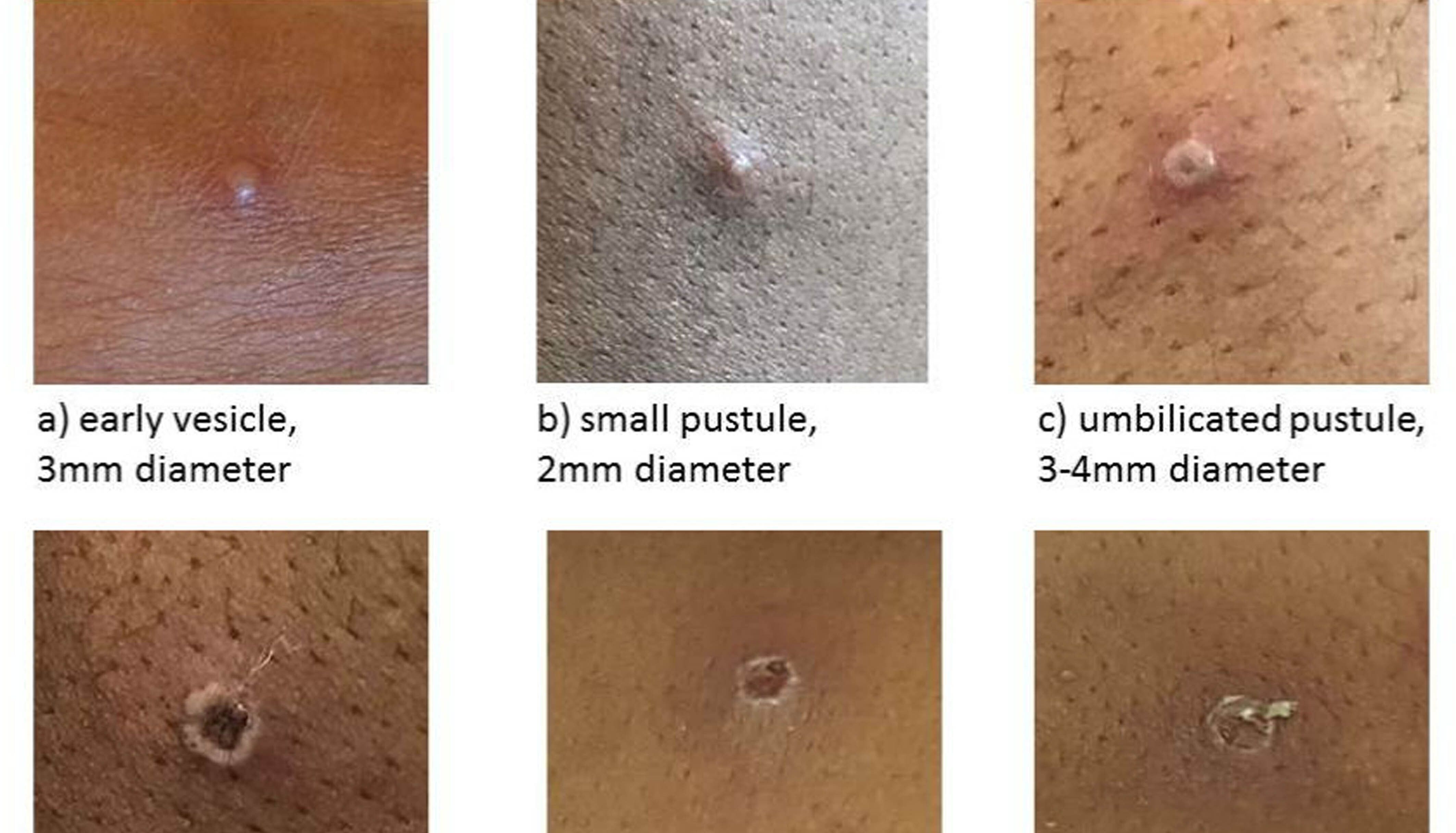 Undated handout image issued by the UK Health Security Agency of the stages of Monkeypox