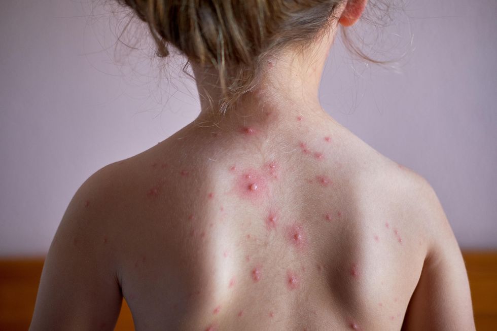 Undated Handout Photo of a little girl with chickenpox. See PA Feature HEALTH Monkeypox. Picture credit should read: PA Photo/Alamy. WARNING: This picture must only be used to accompany PA Feature HEALTH Monkeypox.