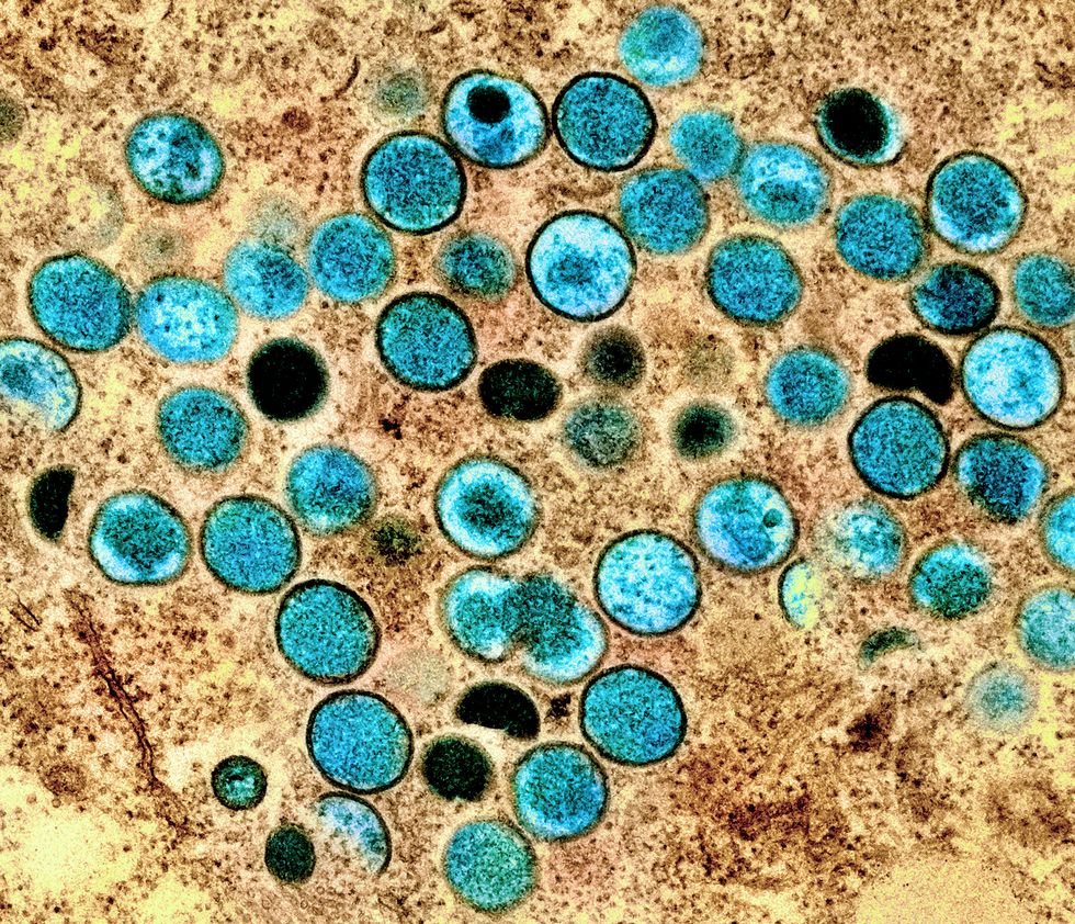 Undated NIAID handout of a colorized transmission electron micrograph of monkeypox particles