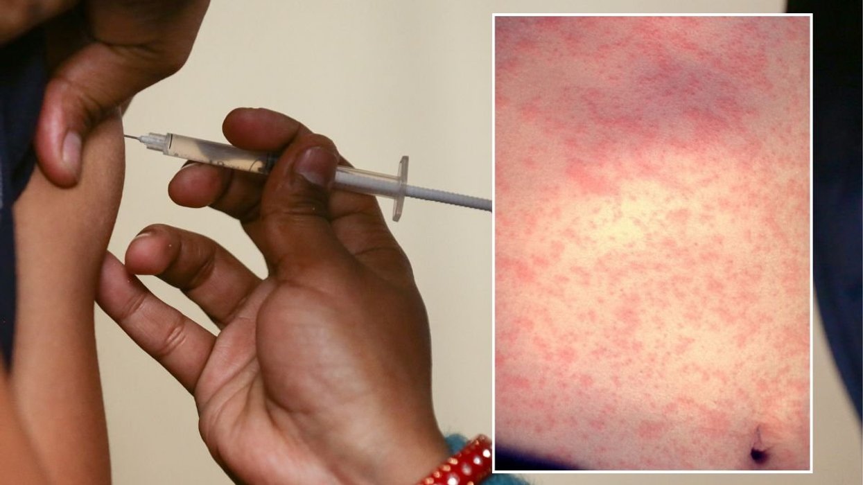 vaccine and measles rash
