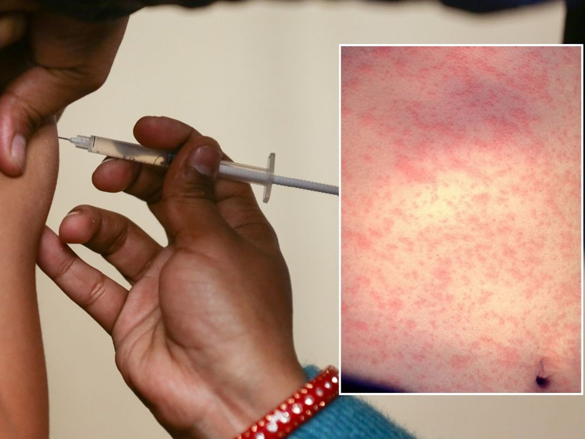 vaccine and measles rash