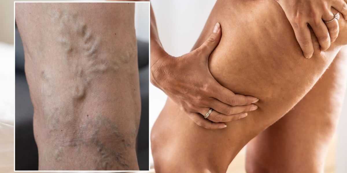 NextImg:Varicose veins: Doctor shares 'simple' daily moves for better blood flow - 'Doesn't have to be strenuous'