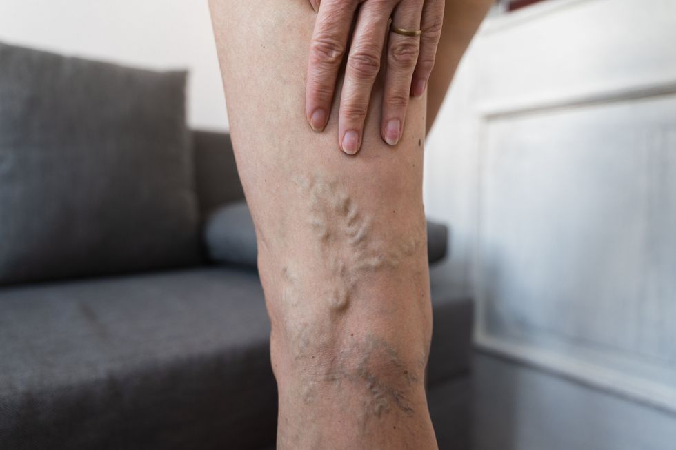 varicose veins
