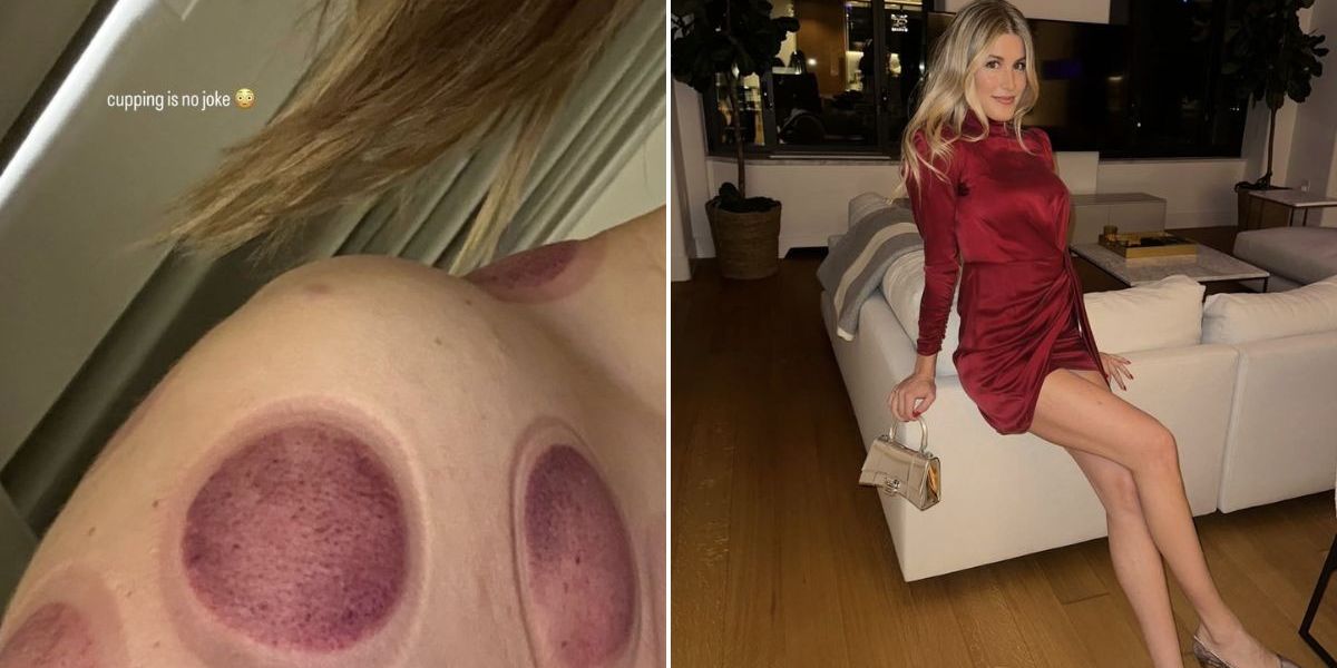NextImg:Eugenie Bouchard shares horrific snaps of cupping treatment after celebrating birthday