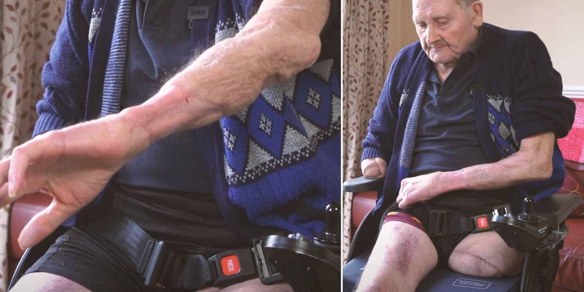 NextImg:Dog attack leaves pensioner needing his arm and leg amputated after being 'ripped to shreds'