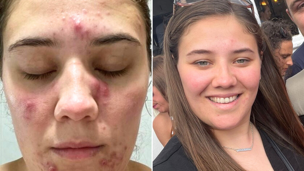 Woman before after skin transformation