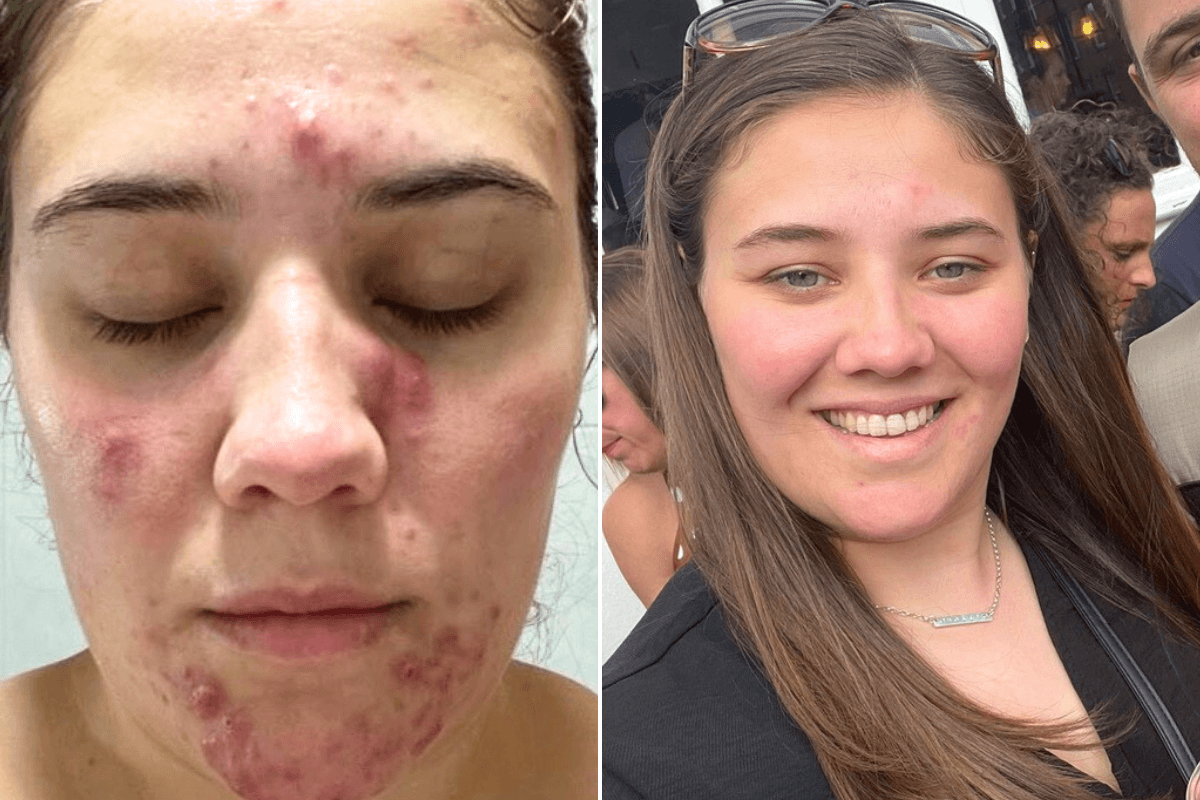 Woman before after skin transformation