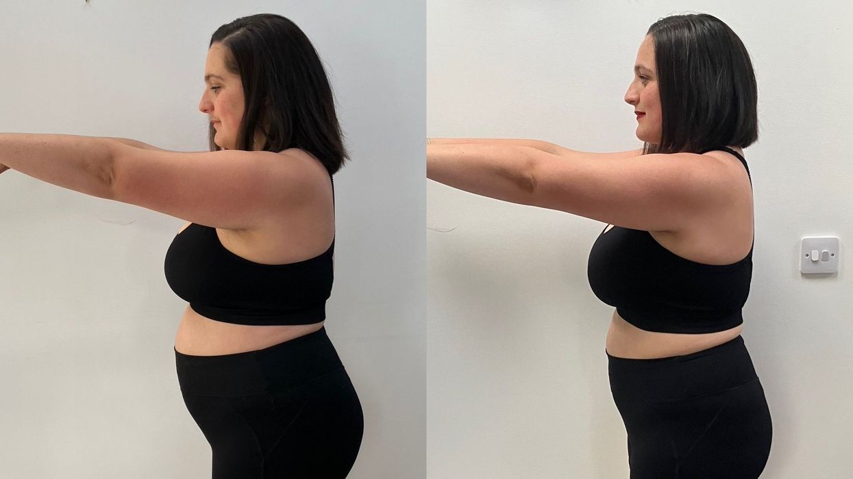 Woman before/after weight loss