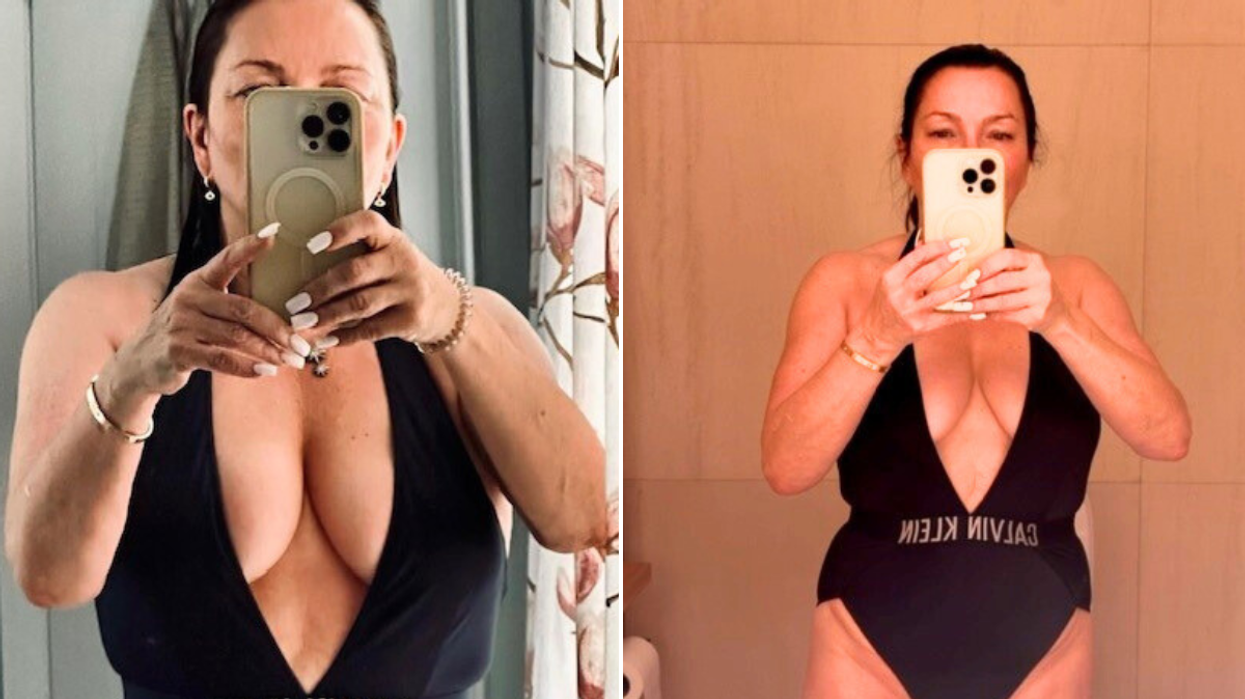 Woman before after weight loss