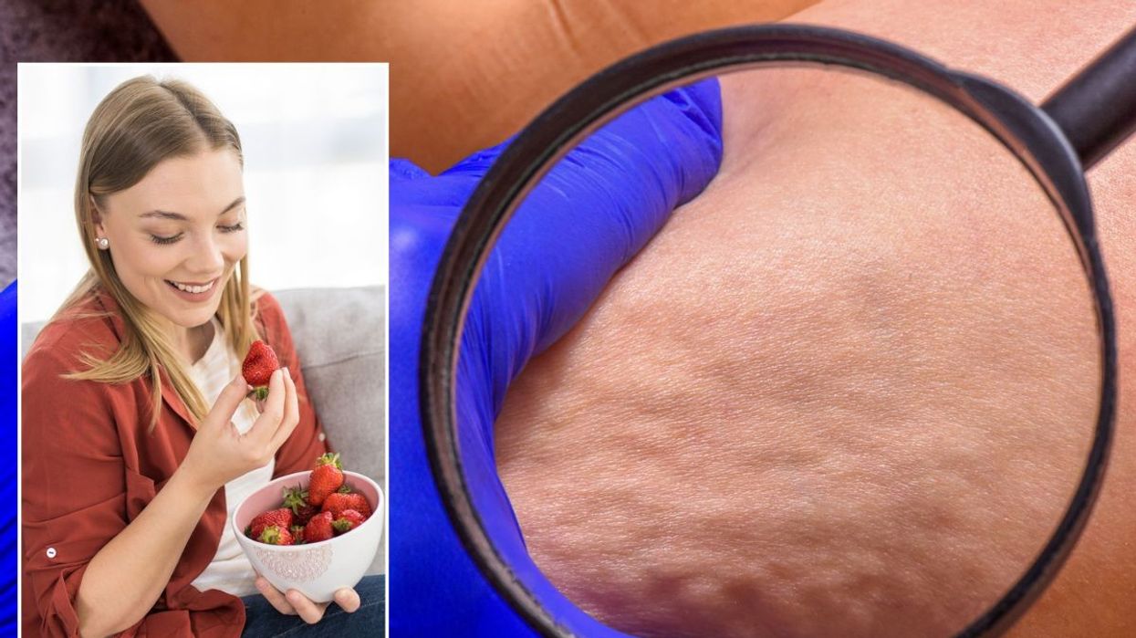 Woman eating berries / Cellulite