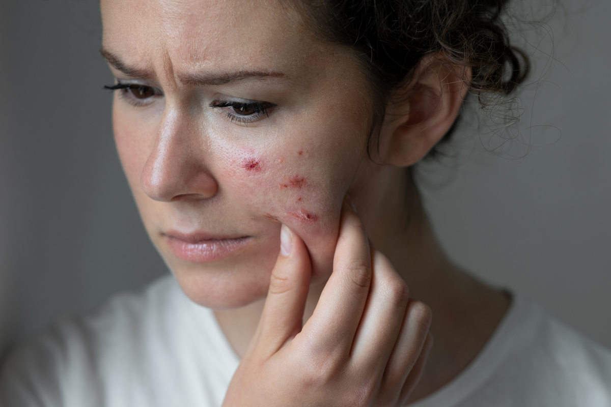 Woman holding her face which has rashes on it 
