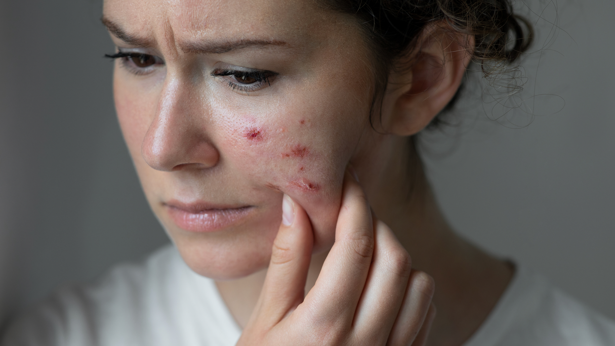 Woman holding her face which has rashes on it