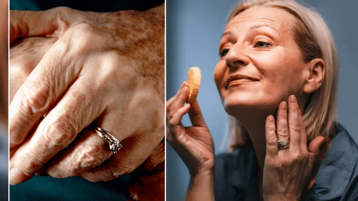 woman's hands with age spots