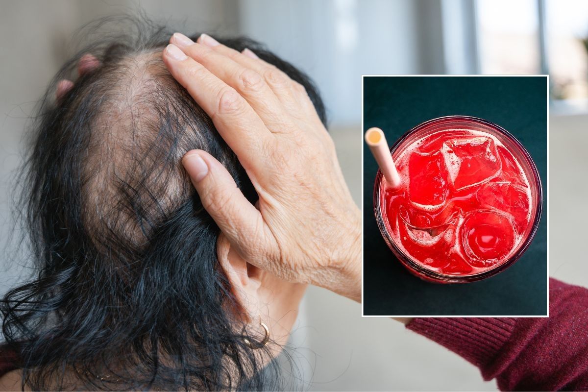 WOMAN SUFFERING HAIR LOSS