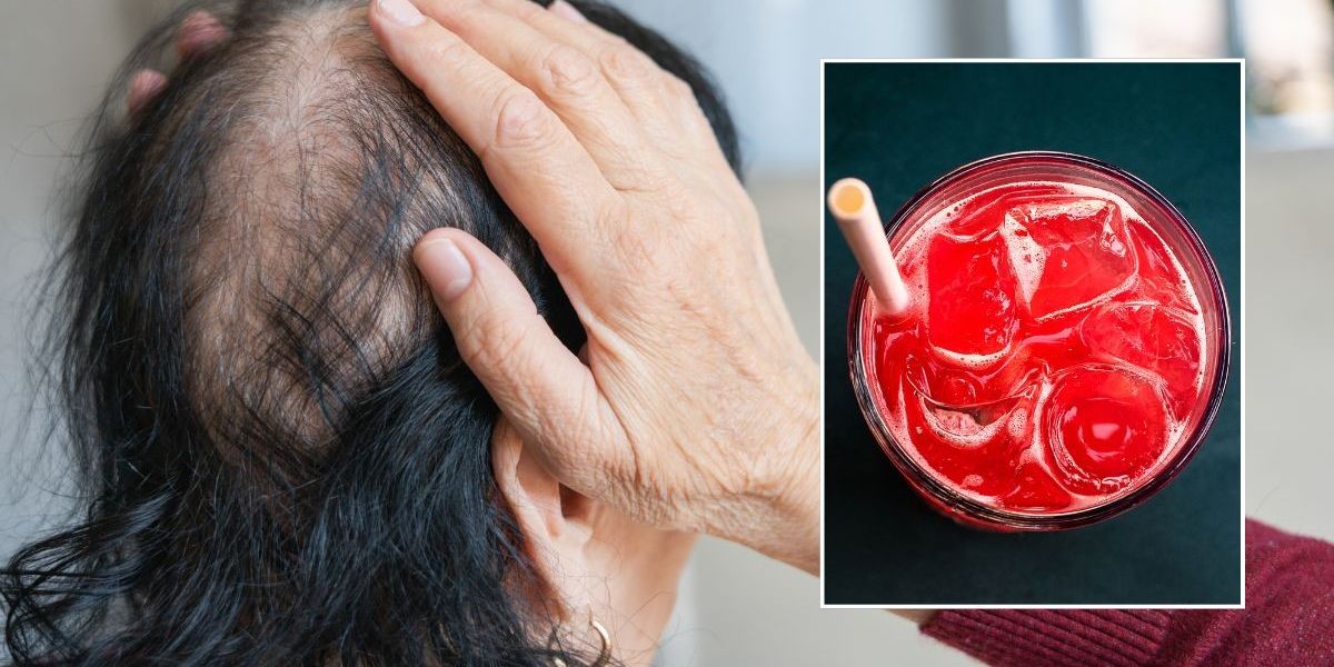 Elevated hair loss risk tied to drink loved by millions of Britons Elevated hair loss risk tied to drink loved by millions of Britons