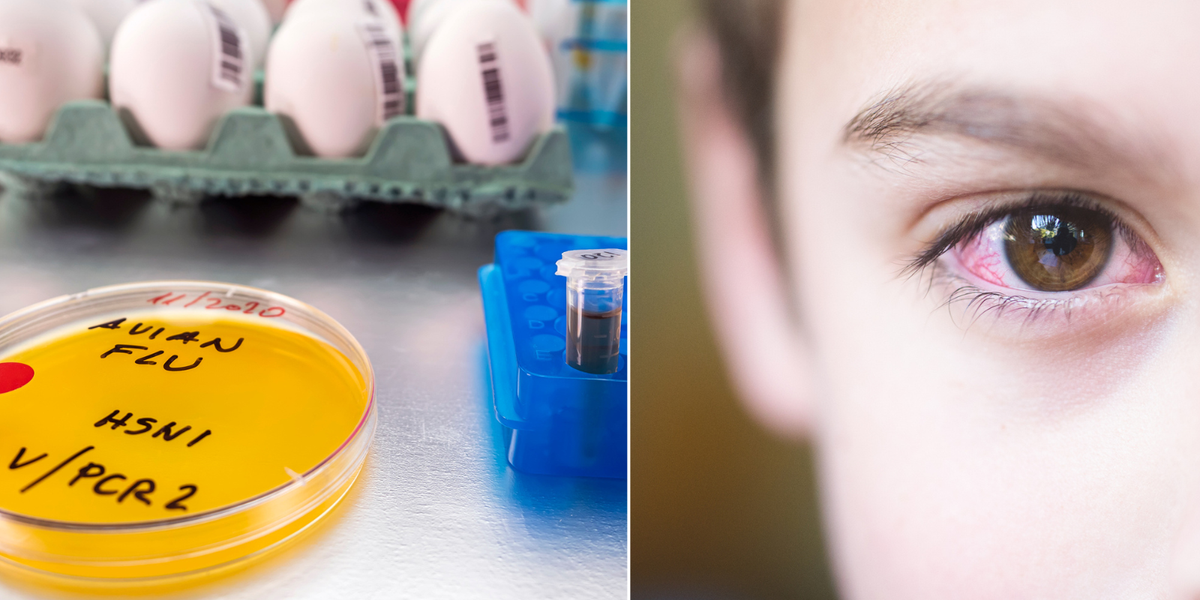 Child tests positive for bird flu after suffering conjunctivitis as pandemic fears grow