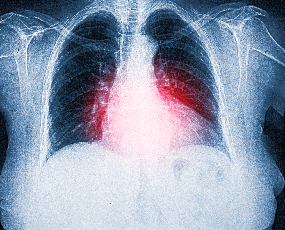 X-ray of the torso of a 73-year-old woman with a possible fracture
