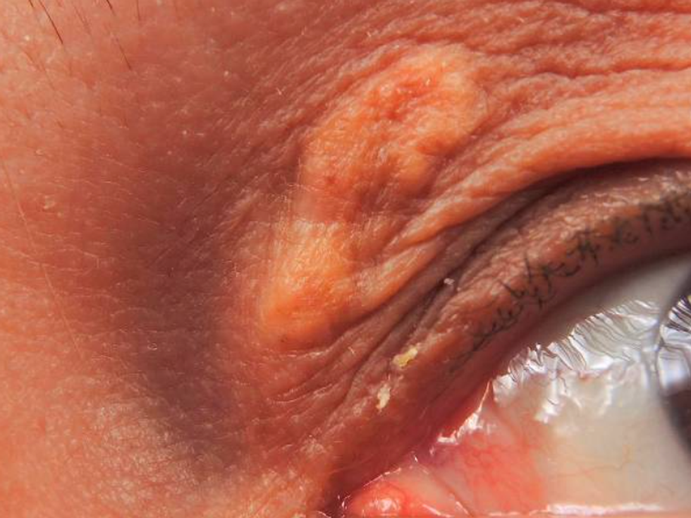 xanthelasma
