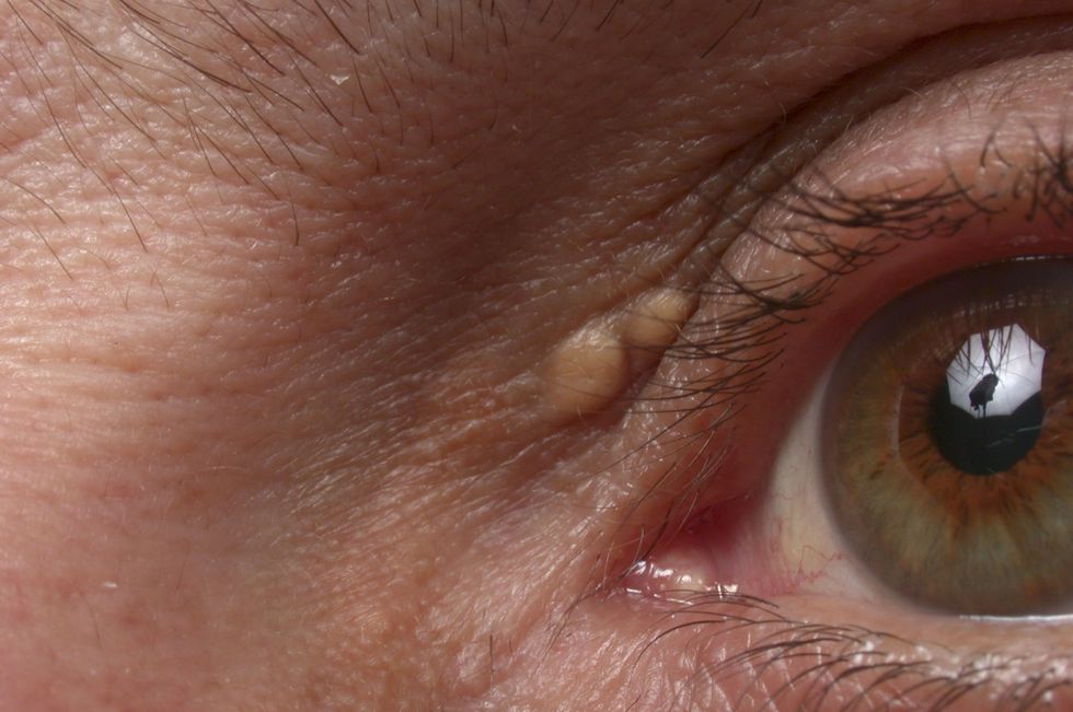 yellow bumps on eyelid